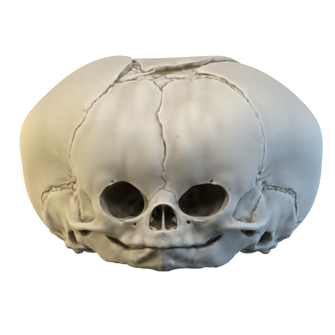 Conjoined fetal human skull 3D printable model